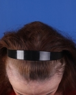 Before Hair Transplant&nbsp;Hairline